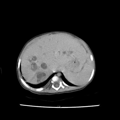Caroli disease with autosomal recessive polycystic kidney disease (ARPKD) (Radiopaedia 89651-106703 B 34).jpg