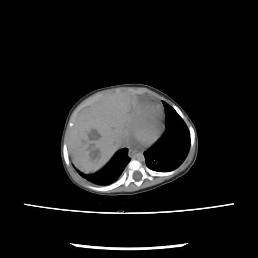 Caroli disease with autosomal recessive polycystic kidney disease (ARPKD) (Radiopaedia 89651-106703 E 18).jpg