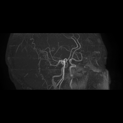 Carotid arterial dissection with acute cerebral infarction (Radiopaedia 26636-26784 MRA 16).jpg