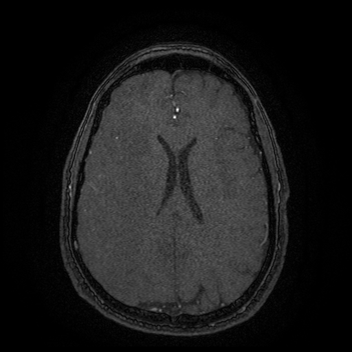 Carotid arterial dissection with acute cerebral infarction (Radiopaedia 26636-26784 MRA 50).jpg