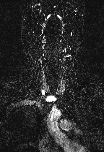 Carotid artery dissection (Radiopaedia 28441-28689 Coronal MRA 20).jpg