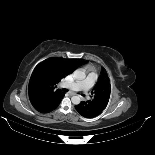 File:Carotid body tumor (Radiopaedia 21021-20948 A 36).jpg