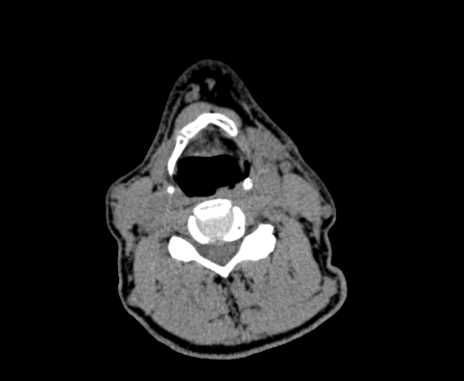 Carotid body tumor (Radiopaedia 61750-69757 Axial non-contrast 59).jpg