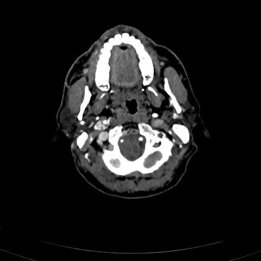 Carotid body tumor (Radiopaedia 83615-98727 A 32).jpg