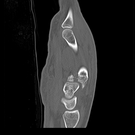 File:Carpo-metacarpal fracture-dislocations with hamatum split fracture (Radiopaedia 18482-18343 Sagittal bone window 16).jpg