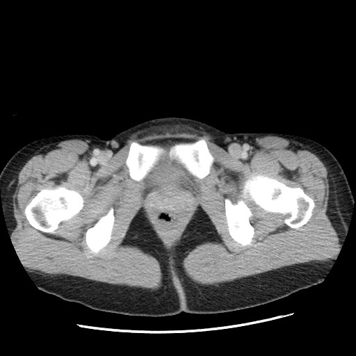 Castleman disease with fibrous pseudotumor in the abdomen (Radiopaedia 77296-89373 A 129).jpg