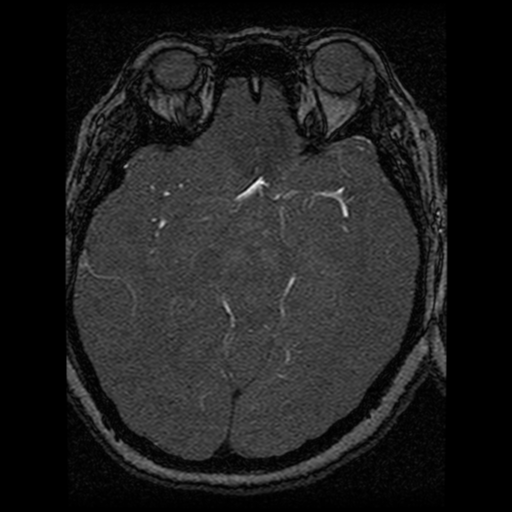 Cavernoma, DVA and right ICA aneurysm (Radiopaedia 33890-35072 E 43).png