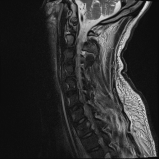 File:Cavernoma of cervical cord (Radiopaedia 50838-56347 C 5).png