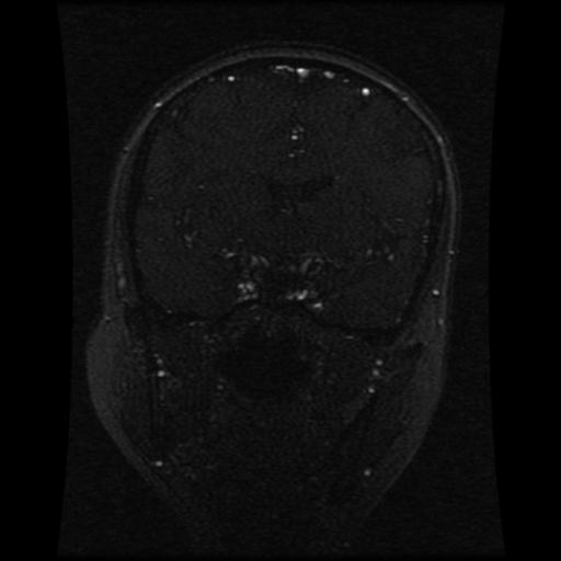 Cavernoma with developmental venous anomaly (Radiopaedia 22470-22507 MRV 82).jpg