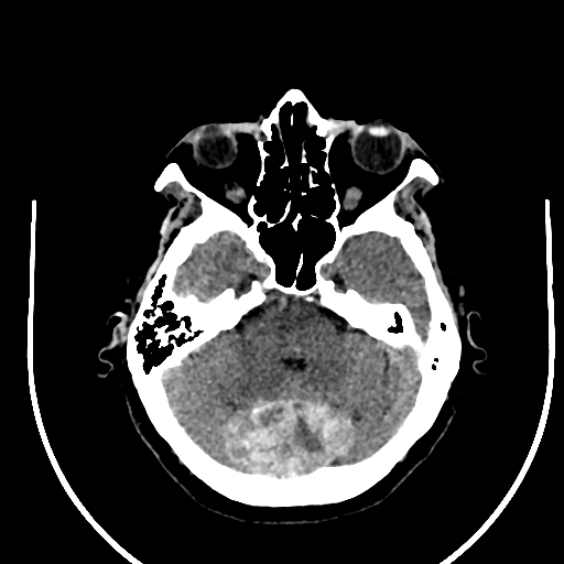 Cavernous hemangioma of the cerebellar falx (Radiopaedia 73025-83723 Axial non-contrast 38).jpg