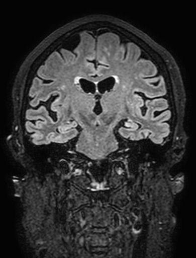 Cavernous hemangioma of the cerebellar falx (Radiopaedia 73025-83724 Coronal FLAIR 184).jpg