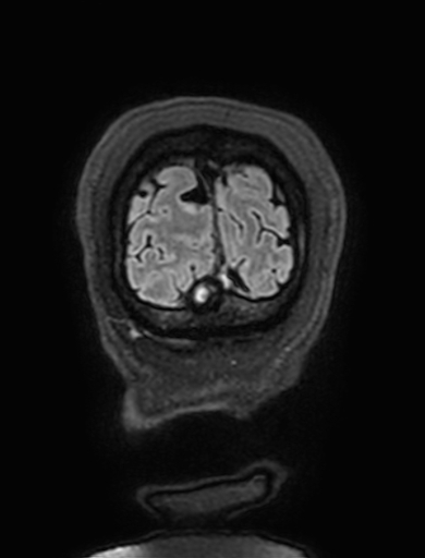 Cavernous hemangioma of the cerebellar falx (Radiopaedia 73025-83724 Coronal FLAIR 337).jpg