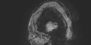Cavernous hemangioma of the cerebellar falx (Radiopaedia 73025-83724 Sagittal BOLD 4).jpg