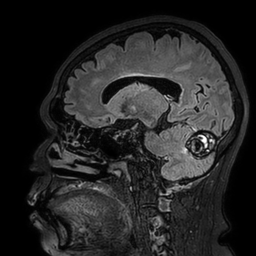 File:Cavernous hemangioma of the cerebellar falx (Radiopaedia 73025-83724 Sagittal FLAIR 84).jpg