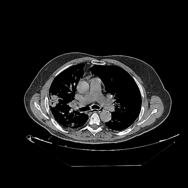 Cavitating bronchogenic carcinoma (Radiopaedia 44489-48162 Axial non-contrast 35).jpg