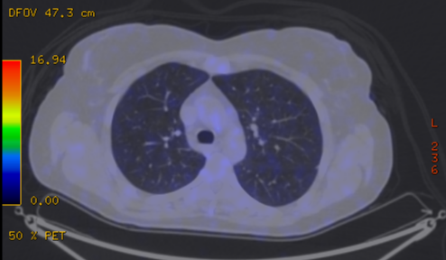 File:Cavitating lung mass - squamous cell carcinoma (Radiopaedia 48047-52853 A 35).png