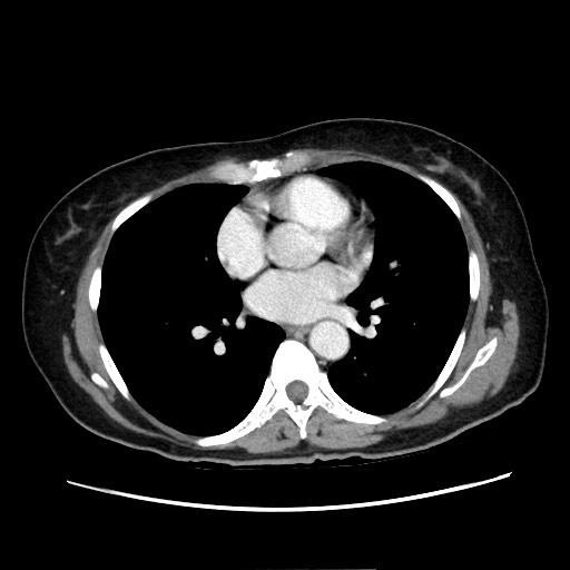 Cecal adenocarcinoma (Radiopaedia 75909-87331 A 4).jpg