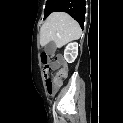 Cecal adenocarcinoma (Radiopaedia 75909-87331 C 23).jpg