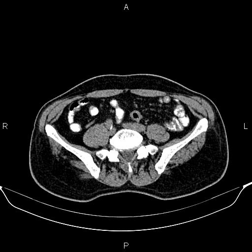 File:Cecal adenocarcinoma (Radiopaedia 85324-100916 Axial non-contrast 66).jpg