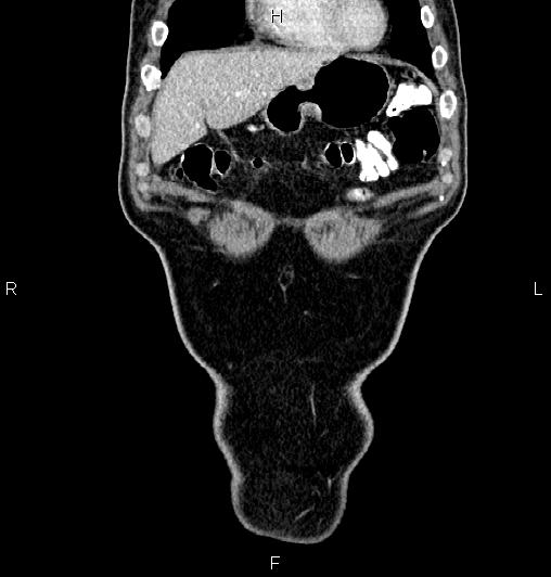 Cecal adenocarcinoma (Radiopaedia 85324-100916 D 8).jpg