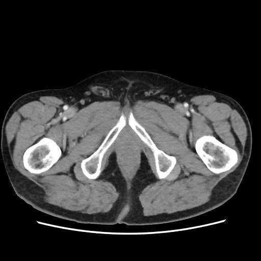 Cecal mass causing appendicitis (Radiopaedia 59207-66531 A 93).jpg