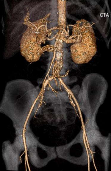 File:Celiac artery severe stenosis and dissection (Radiopaedia 44128-47842 C+ arterial phase 28).jpg