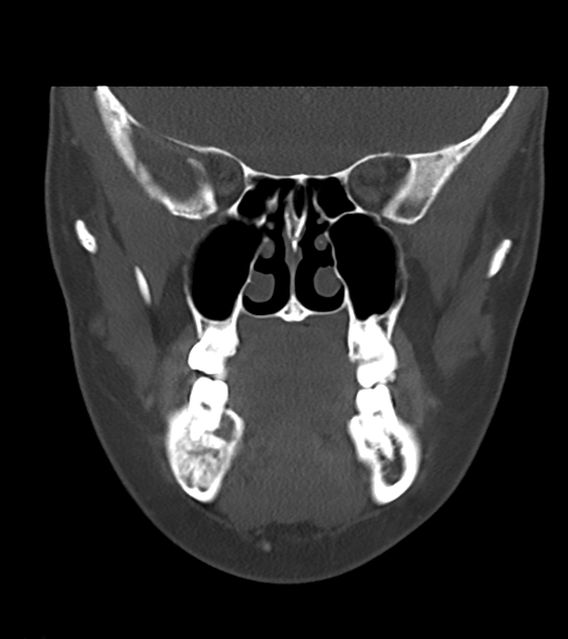 Cemento-ossifying fibroma (Radiopaedia 46243-50643 Coronal bone window 25).png