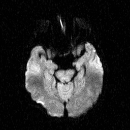 File:Central-variant posterior reversible encephalopathy syndrome (PRES) (Radiopaedia 43880-47358 Axial DWI 8).jpg