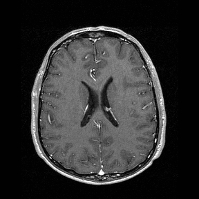 Central-variant posterior reversible encephalopathy syndrome (PRES) (Radiopaedia 43880-47358 Axial T1 C+ 103).jpg