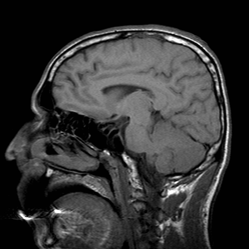 File:Central-variant posterior reversible encephalopathy syndrome (PRES) (Radiopaedia 43880-47358 Sagittal T1 10).jpg