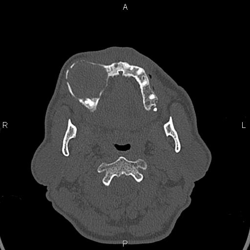 File:Central giant cell granuloma (Radiopaedia 83346-97761 Axial bone window 17).jpg