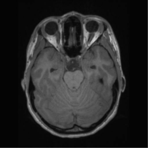 File:Central neurocytoma (Radiopaedia 37664-39557 Axial T1 24).png