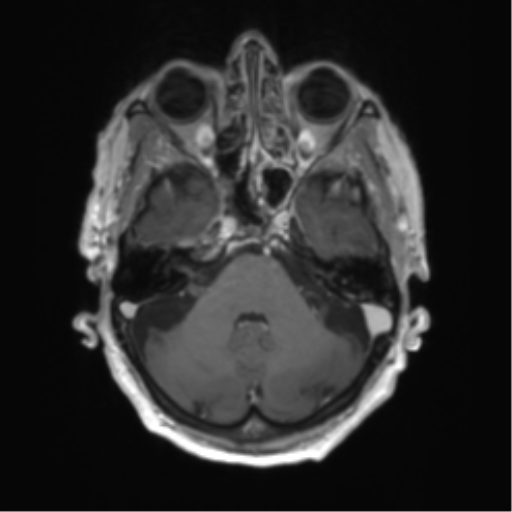 Central neurocytoma (Radiopaedia 65317-74345 Axial T1 C+ 9).png