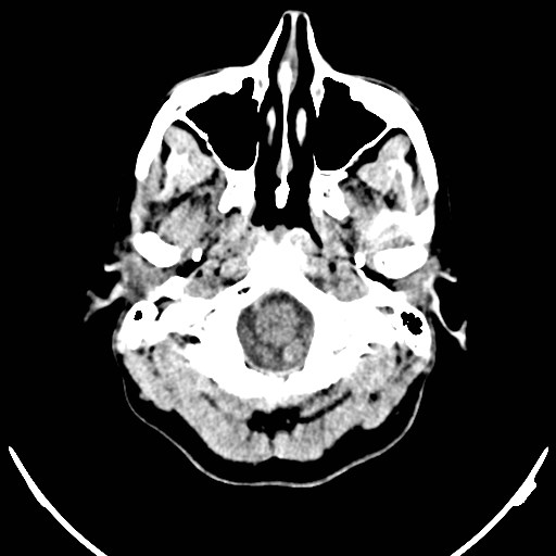 Central neurocytoma (Radiopaedia 84497-99871 Axial non-contrast 1).jpg