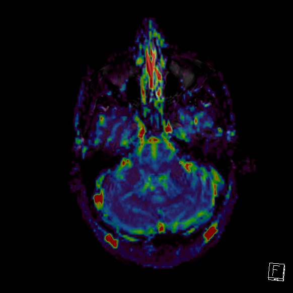 Central neurocytoma (Radiopaedia 84497-99872 Axial Perfusion 246).jpg