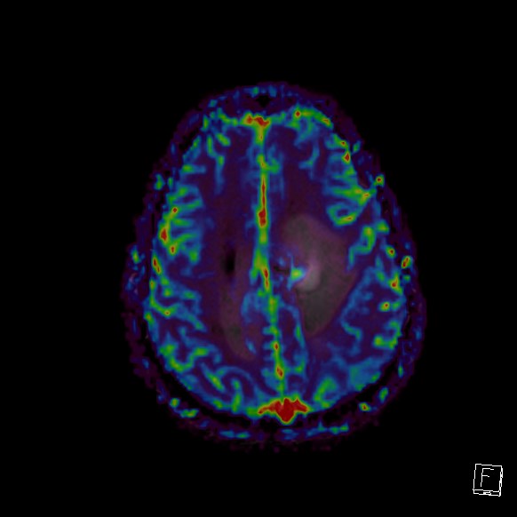 Central neurocytoma (Radiopaedia 84497-99872 Axial Perfusion 88).jpg