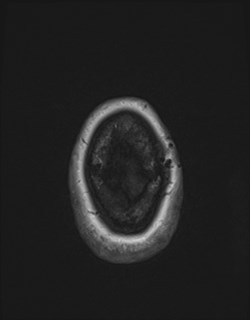 Central neurocytoma (Radiopaedia 84497-99872 Axial T1 176).jpg