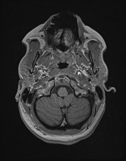 Central neurocytoma (Radiopaedia 84497-99872 Axial T1 32).jpg
