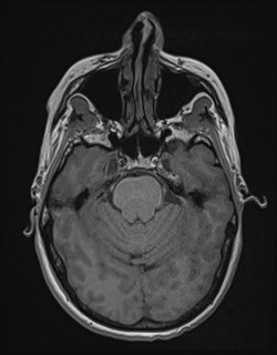 Central neurocytoma (Radiopaedia 84497-99872 Axial T1 66).jpg