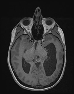 Central neurocytoma (Radiopaedia 84497-99872 Axial T1 86).jpg