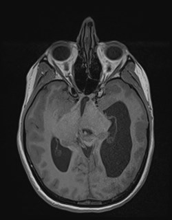 File:Central neurocytoma (Radiopaedia 84497-99872 Axial T1 87).jpg