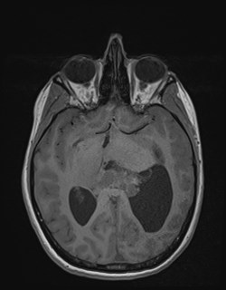Central neurocytoma (Radiopaedia 84497-99872 Axial T1 94).jpg