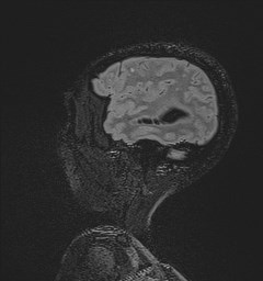 File:Central neurocytoma (Radiopaedia 84497-99872 Sagittal Flair + Gd 126).jpg