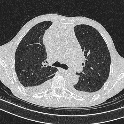 Central venous catheter tip extravasation (Radiopaedia 82828-97113 Axial lung window 36).jpg