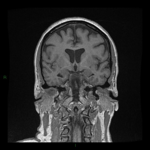 Cerebellar abscess (Radiopaedia 78135-90678 Coronal T1 C+ 74).jpg