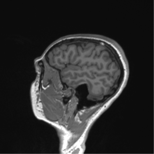 Cerebellar agenesis with hypoplastic pons (pontocerebellar hypoplasia) (Radiopaedia 57224-64138 Sagittal T1 18).png