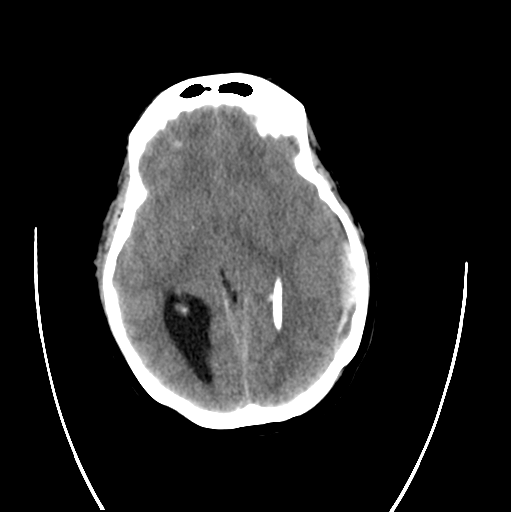 File:Cerebellar ependymoma complicated by post-operative subdural hematoma (Radiopaedia 83322-97737 Coronal non-contrast 1).png