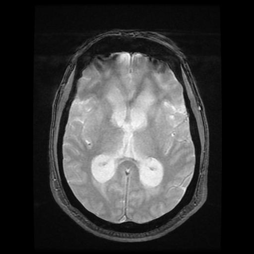 File:Cerebellar hemangioblastoma (Radiopaedia 88055-104622 Axial Gradient Echo 11).jpg