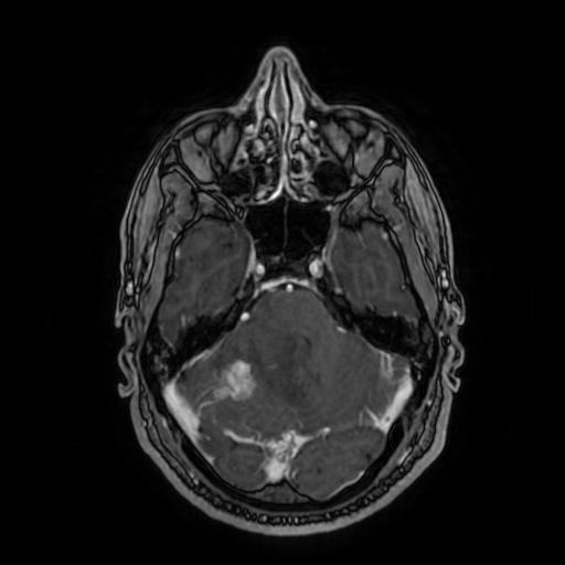 Cerebellar hemangioblastoma (Radiopaedia 88055-104622 Axial T1 C+ 63).jpg