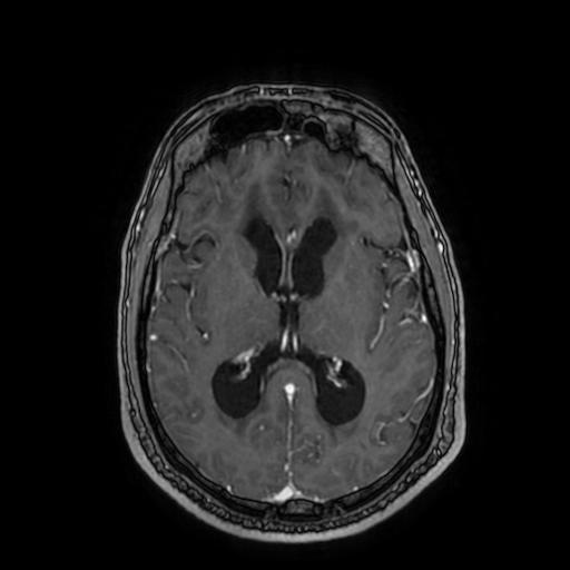 Cerebellar hemangioblastoma (Radiopaedia 88055-104622 Axial T1 C+ 99).jpg